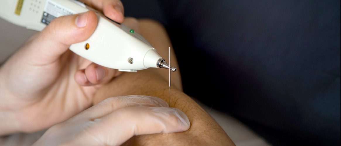 Nahaufnahme Elektro-Dry-Needling an der Wade - iStock