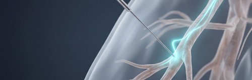 Künstliche Darstellung einer Elektro-Dry-Needling Stimmulation